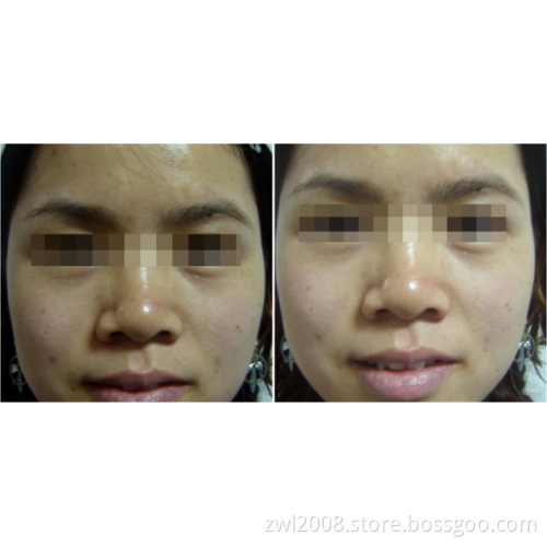 Sptf+ - Advanced IPL (FDA Approved)